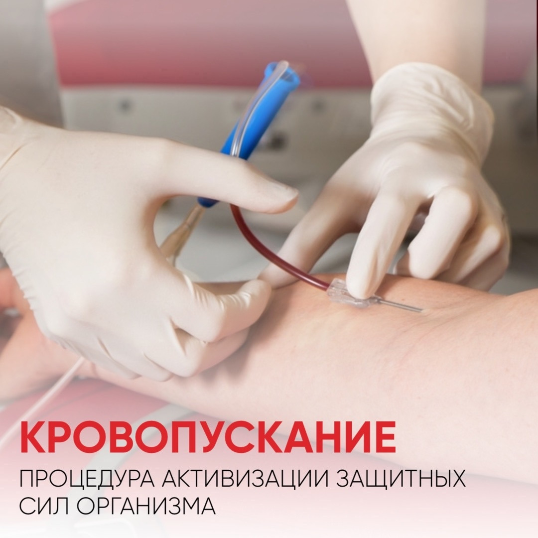 Венозное кровопускание для улучшения микроциркуляции